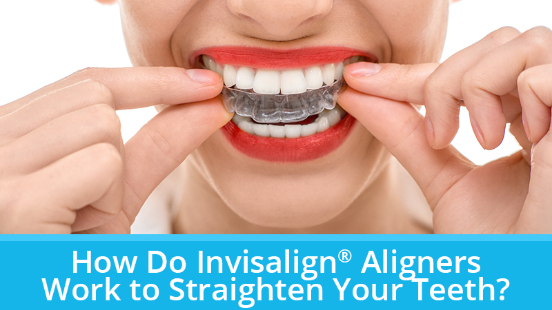 How Do Invisalign® Aligners Work to Straighten Your Teeth?