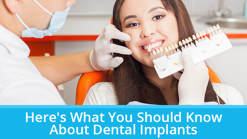 Here's What You Should Know About Dental Implants