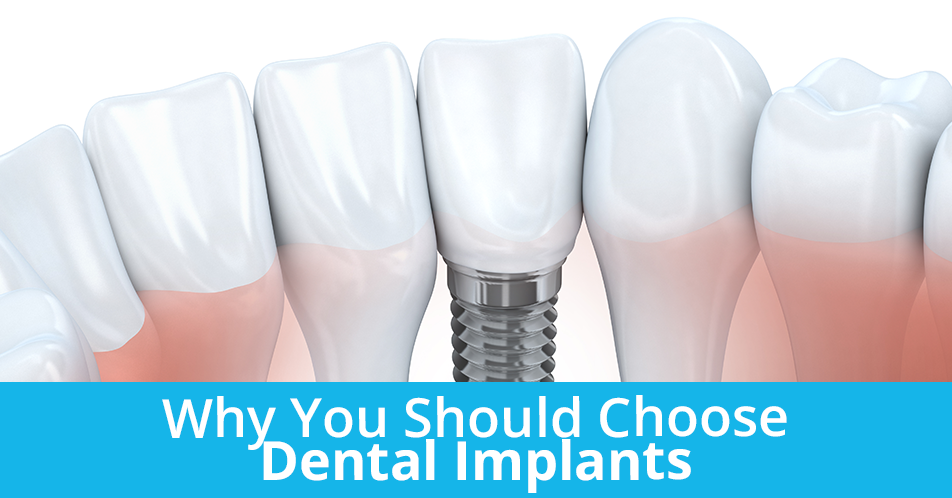 Why You Should Choose Dental Implants
