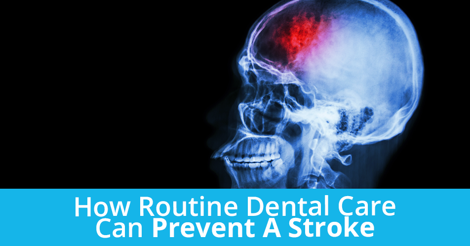 How Routine Dental Care Can Prevent A Stroke
